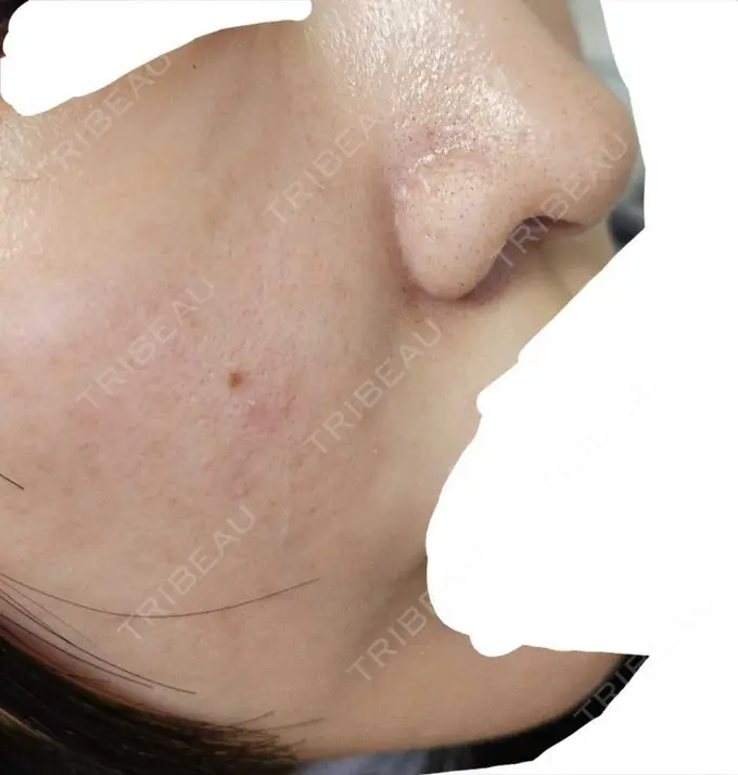 水光注射（ハリ・美肌） オラクル美容皮膚科 名古屋院 BEFORE メイン用