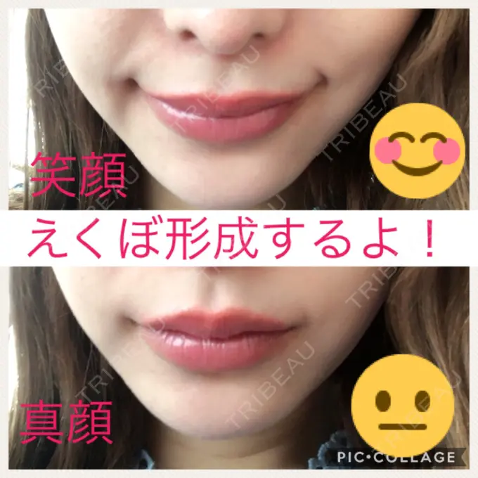 その他（輪郭） / その他（口元） / その他 ドクターゴールドマンクリニック 東京高輪院 BEFORE メイン用