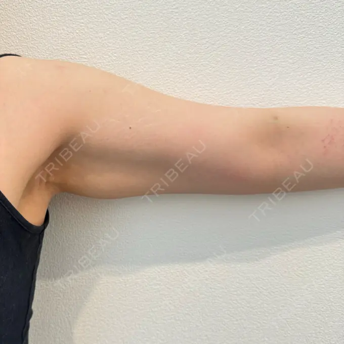 脂肪吸引（二の腕） ルーチェクリニック 銀座院 BEFORE メイン用