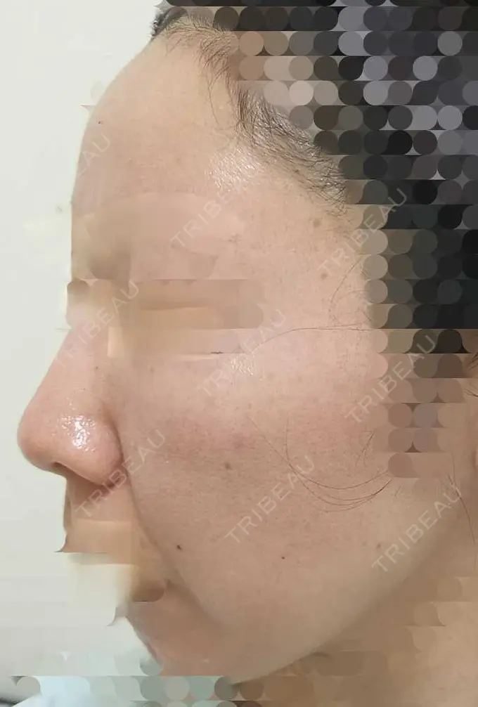 ルメッカ ルラ美容クリニック 神戸院 BEFORE メイン用