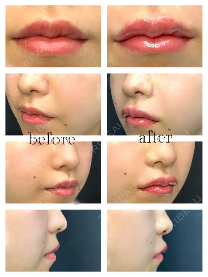 ヒアルロン酸注入（唇） / ボトックス（口角） / ヒアルロン酸注入（鼻翼基部） / その他（鼻） ルラ美容クリニック 渋谷本院 BEFORE メイン用