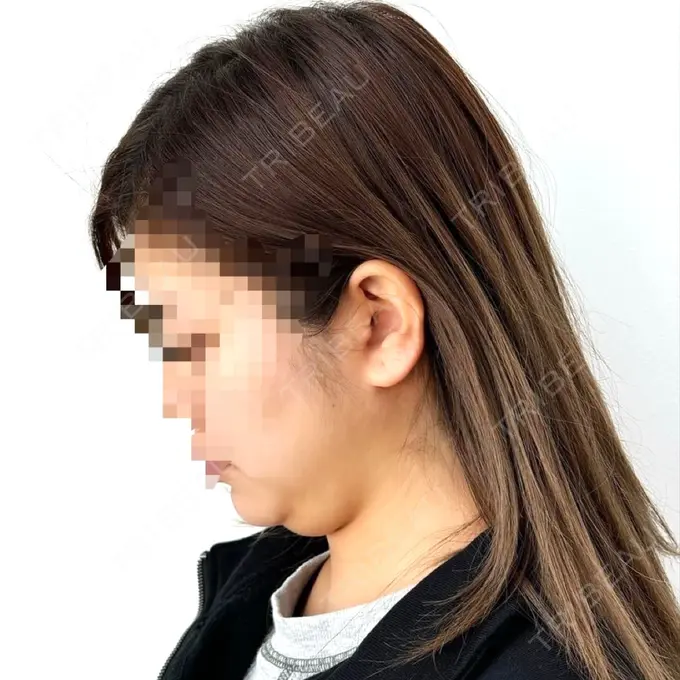 糸リフト / 脂肪吸引（顔） yuzawa clinic BEFORE メイン用