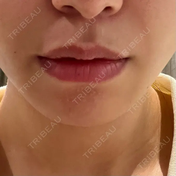 ボトックス（口角） / ボトックス（人中） S-Laboクリニック 渋谷院 BEFORE メイン用