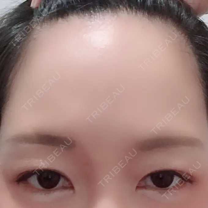 眉下切開 エイペックス美容外科 BEFORE メイン用