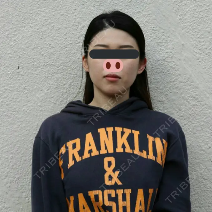 骨切り（あご） / 骨削り（エラ） / 骨削り（頬） / 脂肪吸引（顔） View美容整形外科 BEFORE メイン用