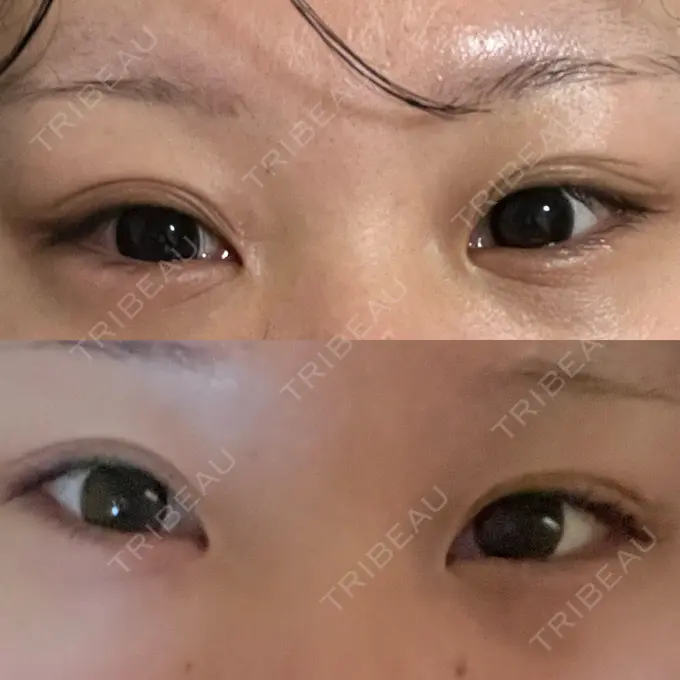二重切開 / 眼瞼下垂（切開） エターナル美容クリニック BEFORE メイン用