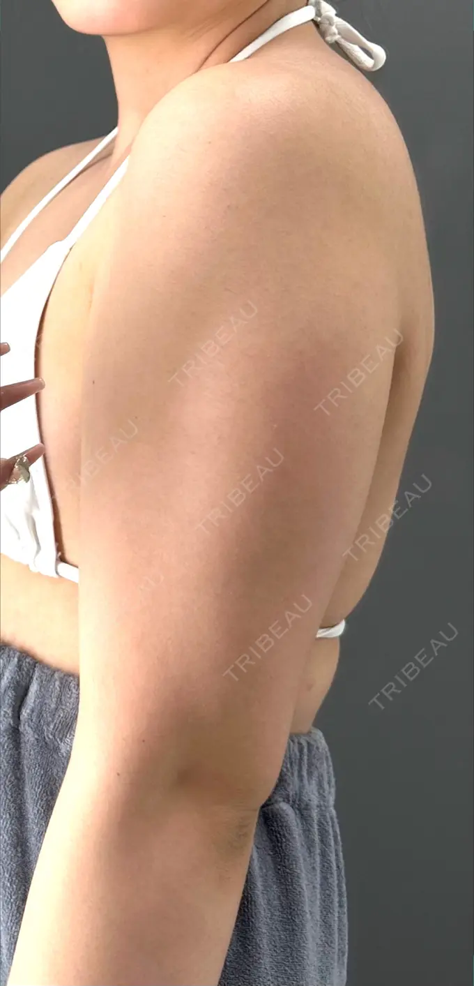 脂肪吸引（二の腕） アムルーズ美容外科クリニック 横浜院 BEFORE メイン用