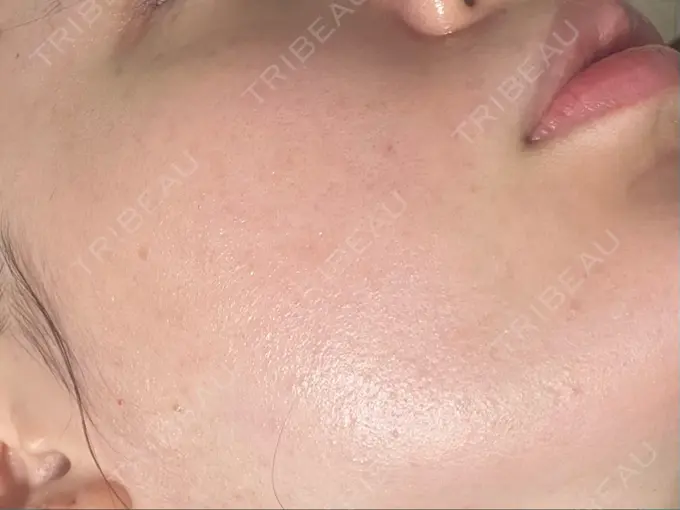 ピーリング（ニキビ・毛穴） 新宿美容外科クリニック 新宿院 BEFORE メイン用