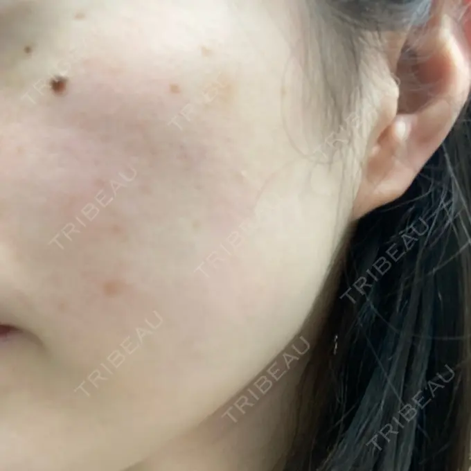 ピーリング（ニキビ・毛穴） / ルメッカ ルラ美容クリニック 広島院 BEFORE メイン用