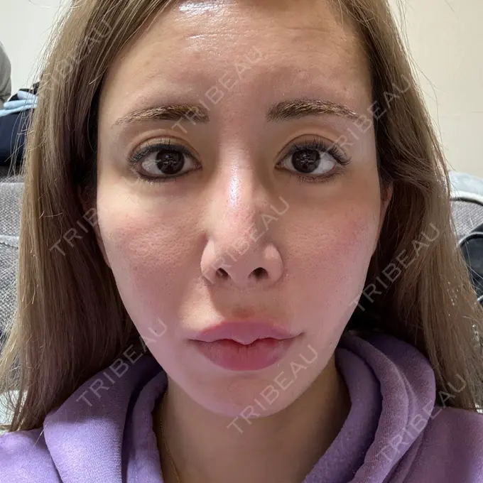 糸リフト / 脂肪吸引（顔） / ヒアルロン酸注入（あご） THE FIRST CLINIC 多摩センター院 BEFORE メイン用