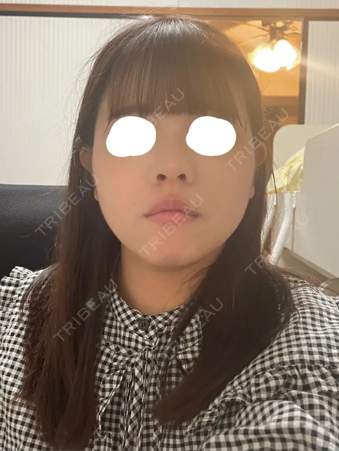 脂肪吸引（顔） / メーラーファット除去 / ボトックス（エラ・小顔） Rosa Beauty Clinic BEFORE メイン用