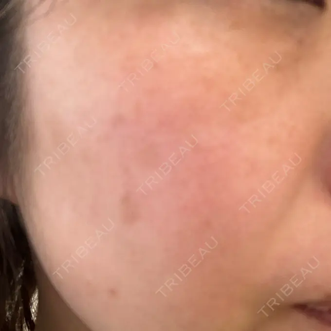 その他（肌） / ピコレーザートーニング（美白・肝斑） SK新宿歌舞伎町美容外科・歯科 BEFORE メイン用