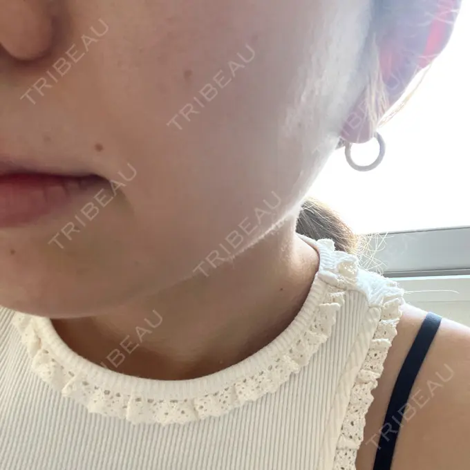 ピーリング（ニキビ・毛穴） 新宿美容外科クリニック 新宿院 BEFORE メイン用