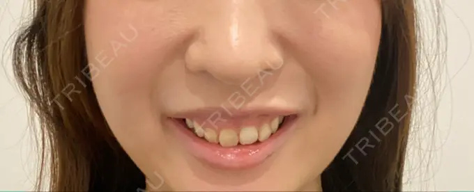 ボトックス（ガミースマイル） 椿クリニック 心斎橋院 BEFORE メイン用