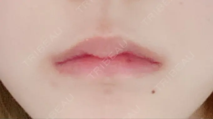 口角挙上 くさのたろうクリニック BEFORE メイン用