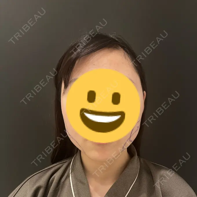 糸リフト / バッカルファット除去 / 脂肪吸引（顔） / ボトックス（エラ・小顔） RIVER CLINIC（リバークリニック） BEFORE メイン用