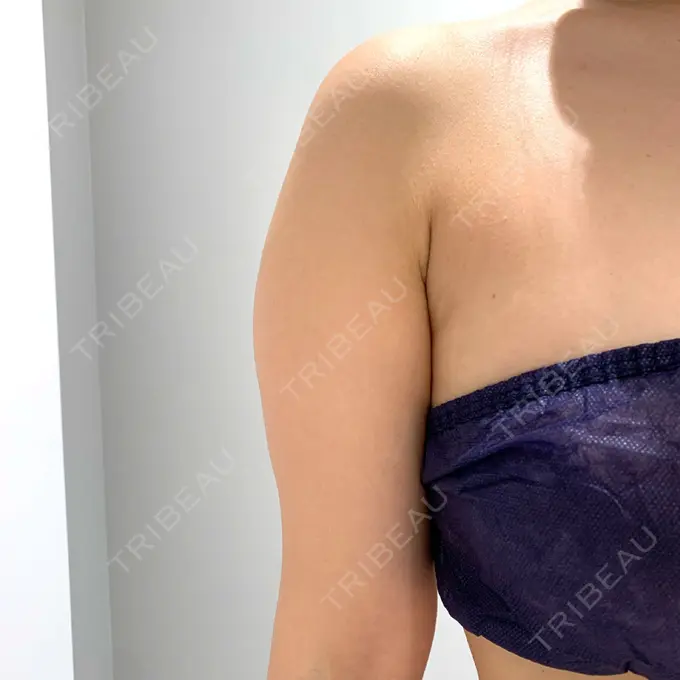 脂肪吸引（二の腕） / 脂肪吸引（肩） Mods Clinic（モッズクリニック） 名古屋院 BEFORE メイン用