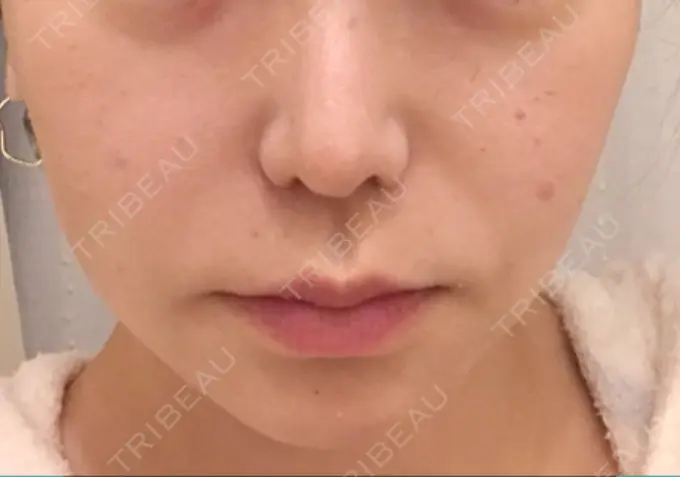 フォトRF 東京美容外科 梅田院 BEFORE メイン用