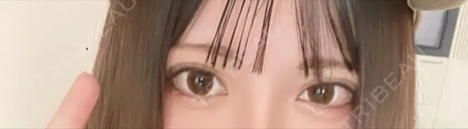 ボトックス（タレ目） 新宿TAクリニック BEFORE メイン用