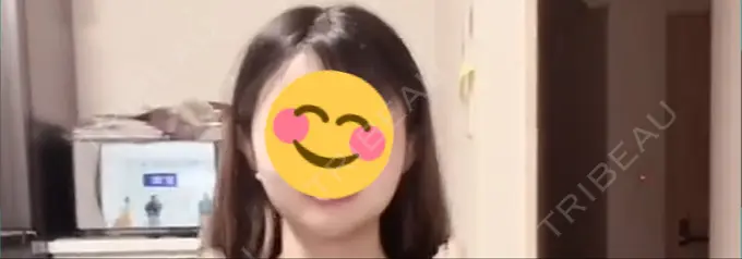 ボトックス（エラ・小顔） ビューティースキンクリニック 渋谷院 BEFORE メイン用