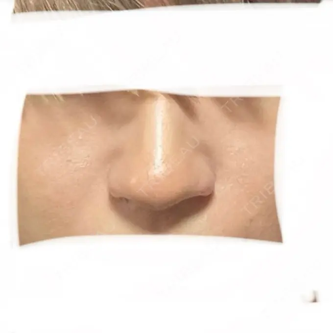 ヒアルロン酸注入（鼻翼基部） ジョウクリニック 大阪院 BEFORE メイン用