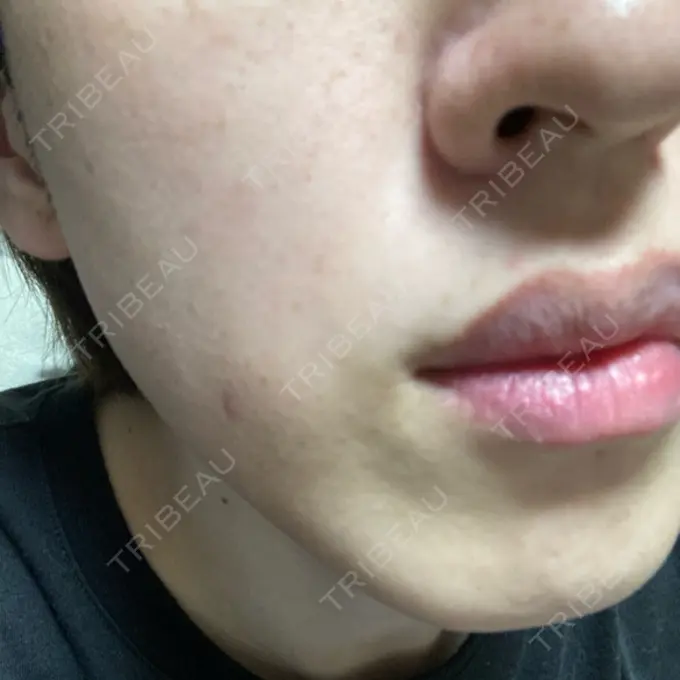 光治療（フォトフェイシャルなど） ミニマムスキンクリニック池袋 BEFORE メイン用