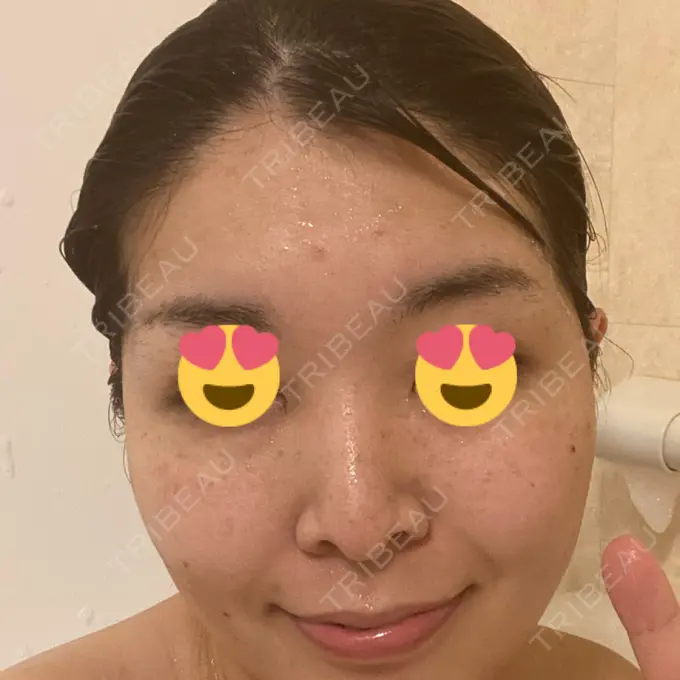 ルメッカ ゆきスキンクリニック 東池袋 BEFORE メイン用