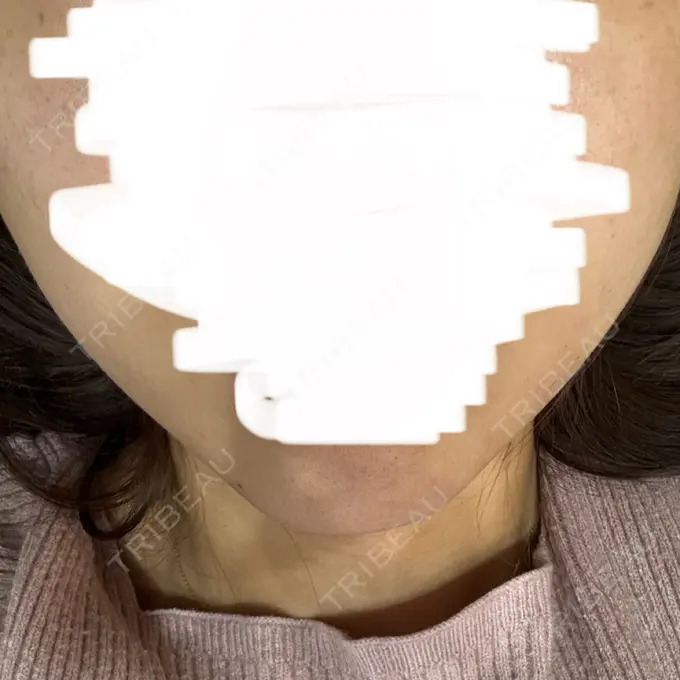 ボトックス（エラ・小顔） TCB東京中央美容外科 豊橋院 BEFORE メイン用