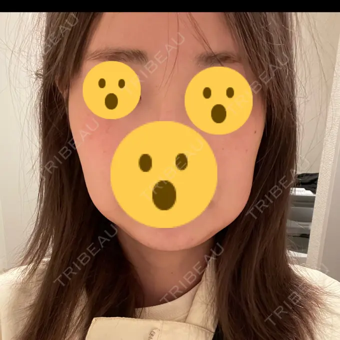 脂肪溶解注射（顔） 表参道ウィズ・クリニック BEFORE メイン用