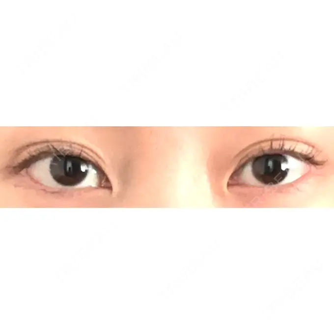 目尻切開 / 目尻靭帯移動 S.T styleクリニック BEFORE メイン用