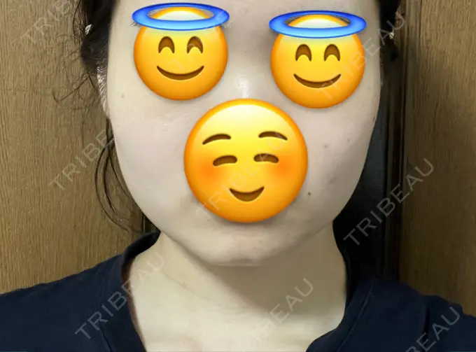 脂肪吸引（顔） Mods Clinic（モッズクリニック） 名古屋院 BEFORE メイン用