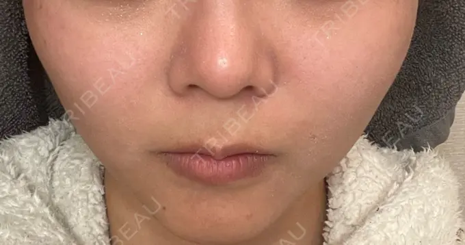 ヒアルロン酸注入（唇） / ボトックス（口角） ルラ美容クリニック 渋谷本院 BEFORE メイン用