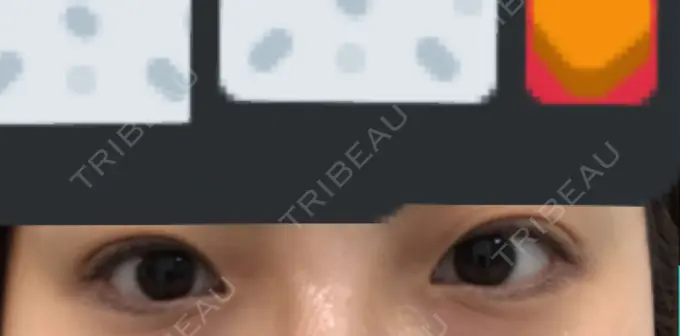 目尻切開 / 自然癒着法 FROM B整形外科 (旧バウム整形外科) BEFORE メイン用