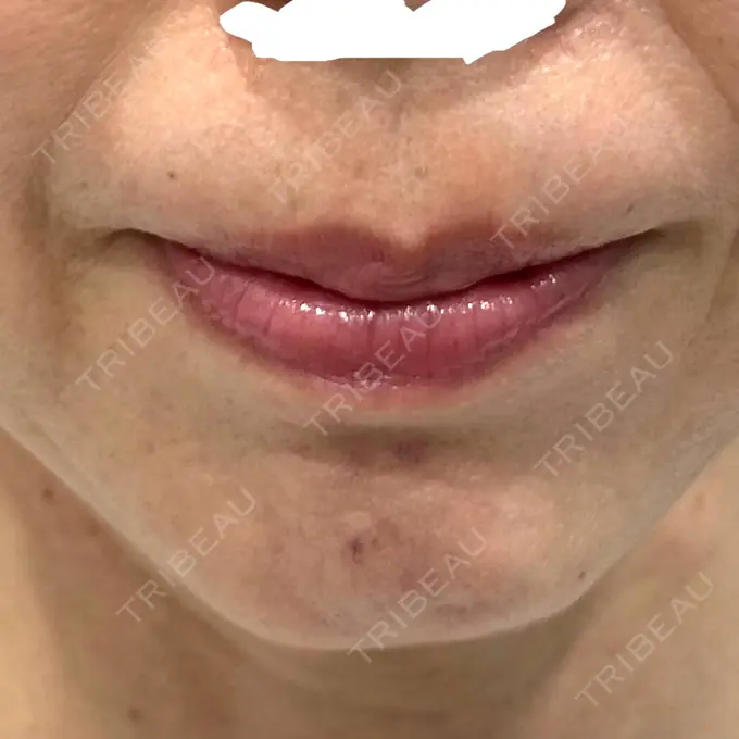 肌ヒアルロン酸注入（たるみ・シワ改善） アリエル美容クリニック 大宮院 BEFORE メイン用