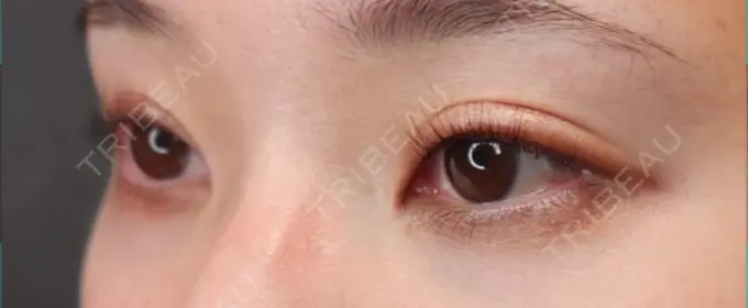 クマ治療 / 目尻切開 / 下まぶたたるみ取り / 下まぶたの脂肪取り / タレ目形成・グラマラスライン（切開） Tokyo Tensei Clinic 新宿院 BEFORE メイン用