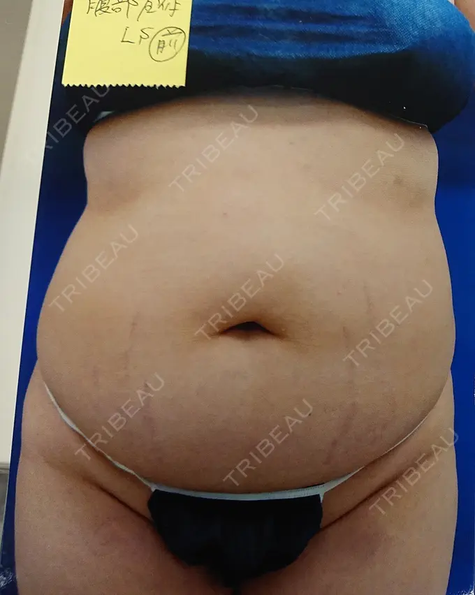 脂肪吸引（お腹） 城本クリニック 岡山院 BEFORE メイン用