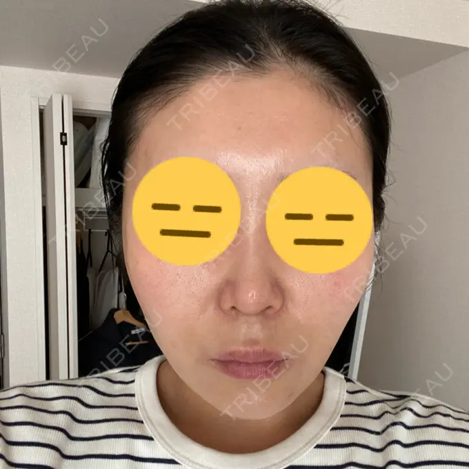 糸リフト / 脂肪吸引注射（顔） 湘南美容クリニック 川崎院 BEFORE メイン用