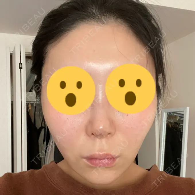 糸リフト 横浜TAクリニック BEFORE メイン用