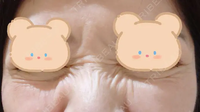 シワ取りボトックス / ボトックス（目尻） 湘南美容クリニック 川崎院 BEFORE メイン用