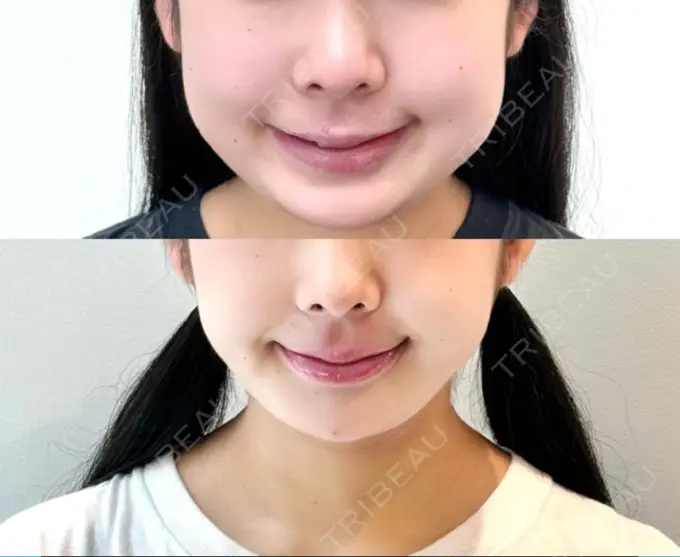 糸リフト / バッカルファット除去 / 脂肪吸引（顔） / メーラーファット除去 / ジョールファット除去 / ヒアルロン酸注入（あご） yuzawa clinic BEFORE メイン用