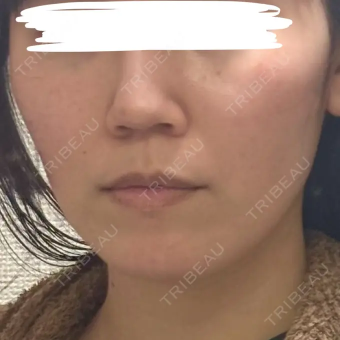 糸リフト / ヒアルロン酸注入（鼻翼基部） 吉祥寺アイビークリニック BEFORE メイン用