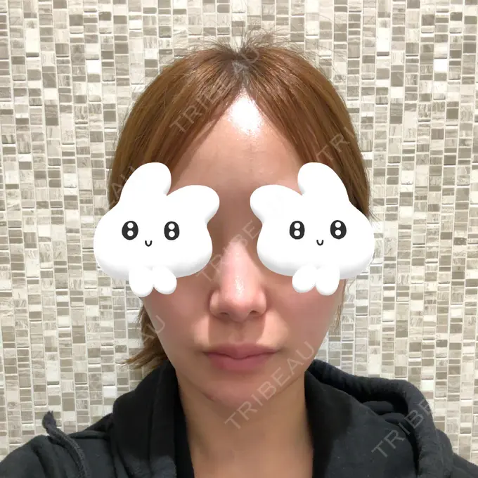 隆鼻術 / 鼻尖形成（切開） / 鼻中隔延長（切開） / 軟骨移植 / 鼻修正 / 鼻孔縁下降 / その他（鼻） Designo Clinic （デジーノクリニック） BEFORE メイン用