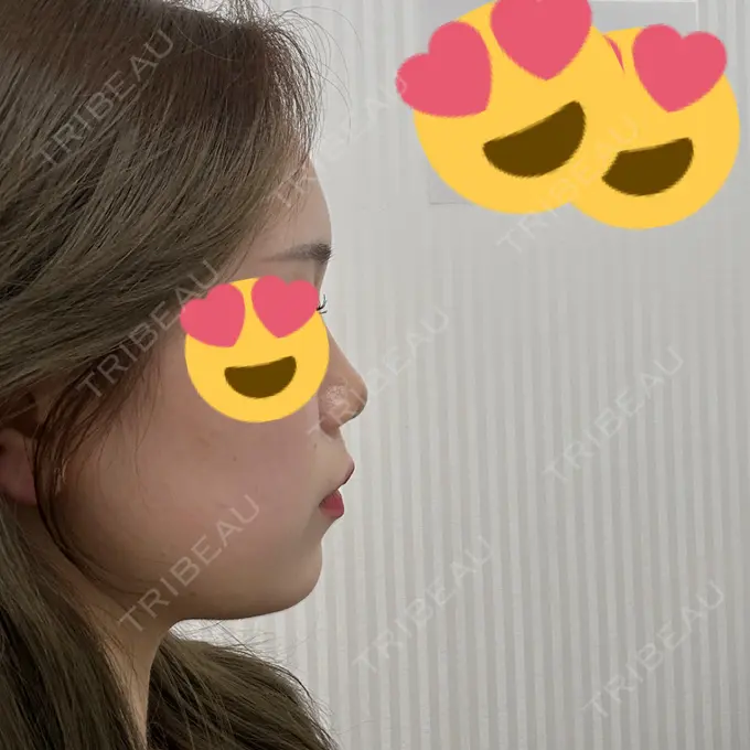 糸リフト / ヒアルロン酸注入（あご） / ボトックス（肩） TCB東京中央美容外科 心斎橋院 BEFORE メイン用