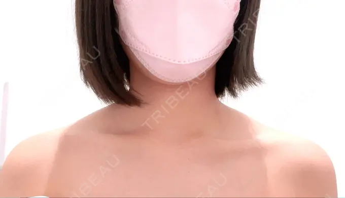 ボトックス（肩） MYCLINIC 西新宿 BEFORE メイン用