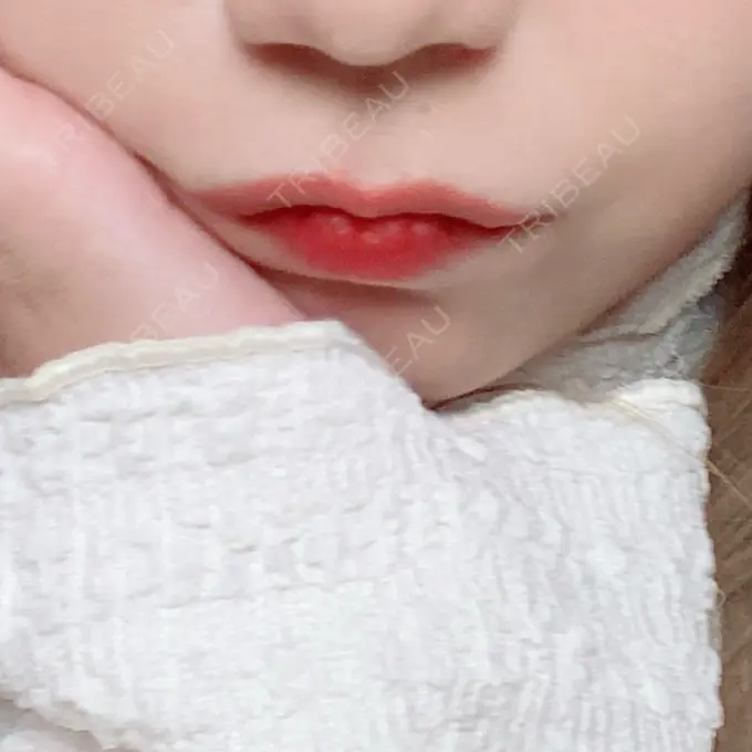 ボトックス（人中） veary clinic BEFORE メイン用