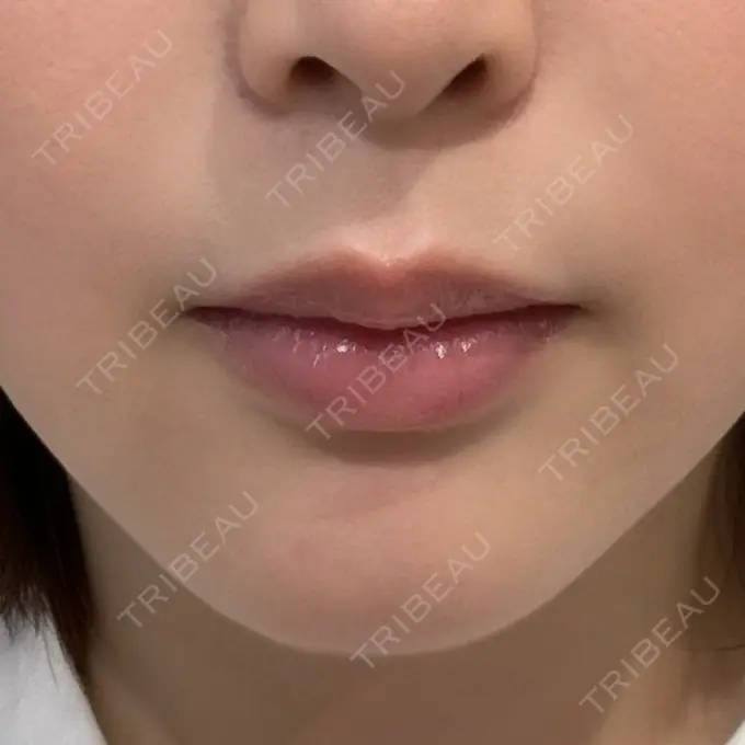 ヒアルロン酸注入（唇） ziz CLINIC BEFORE メイン用