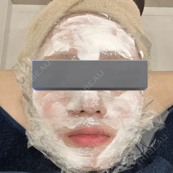 ヴェルヴェットスキン ミニマムスキンクリニック池袋 BEFORE メイン用