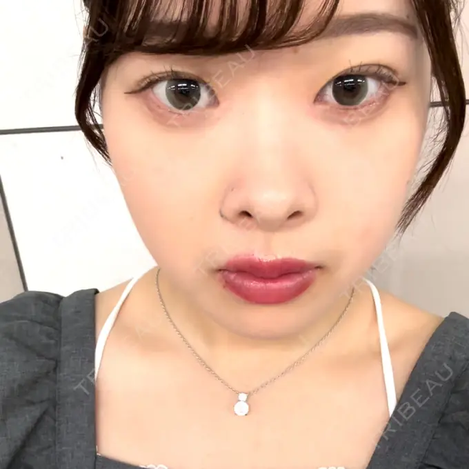 ヒアルロン酸注入（涙袋） 吉祥寺アイビークリニック BEFORE メイン用