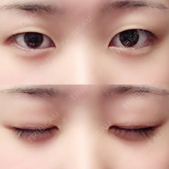 二重切開 / 目頭切開 城本クリニック 豊橋院 BEFORE メイン用