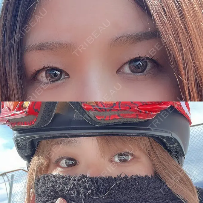 二重埋没 ルネッサンス美容外科医院 神戸院 BEFORE メイン用